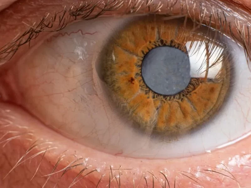 cirurgia-de-catarata-tudo-o-que-voce-precisa-saber-1